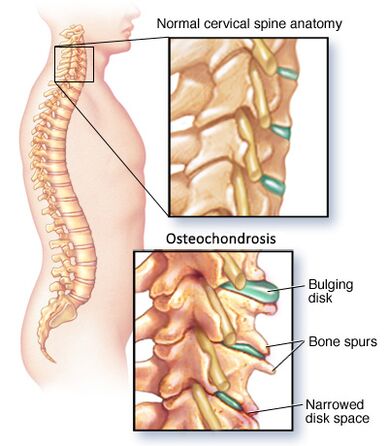 zervikale Osteochondrose