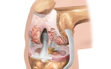 Arthrose des Kniegelenks