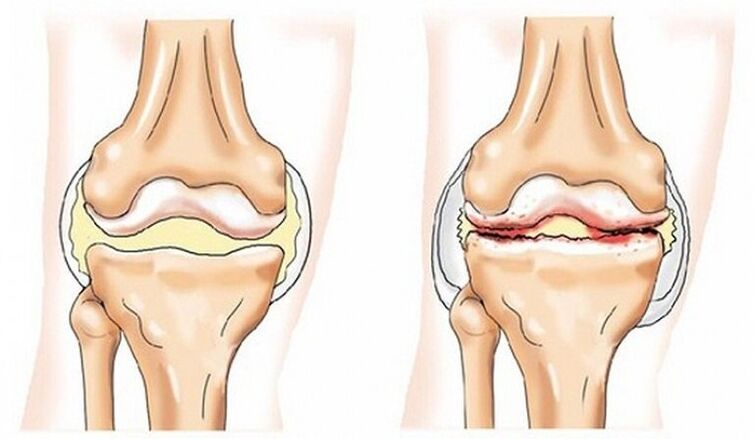 Gesunde und gemeinsame Artikulation, die von Arthrose betroffen ist