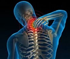 Osteochondrose der Halswirbelsäule