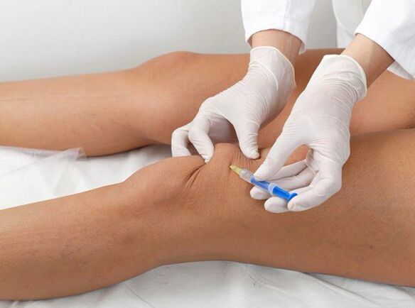 intraartikuläre Injektion bei Knie-Arthrose